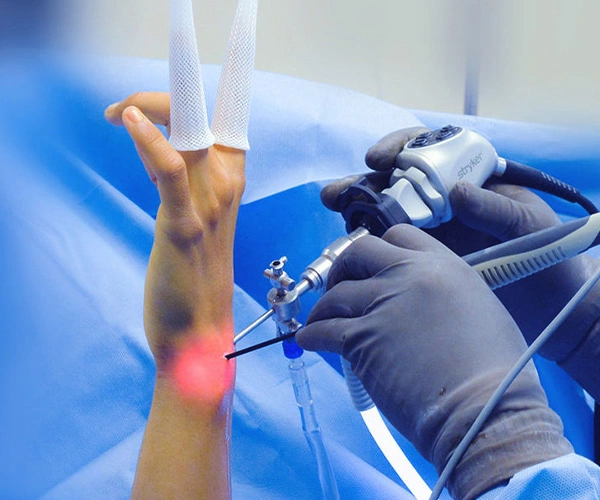 Hand & Wrist Arthroscopy surgery Hand & Wrist Arthroscopy surgery
