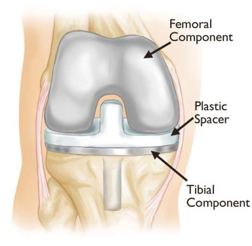 Revision Knee Replacement