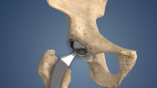 Partial Hip Replacement Partial Hip Replacement
