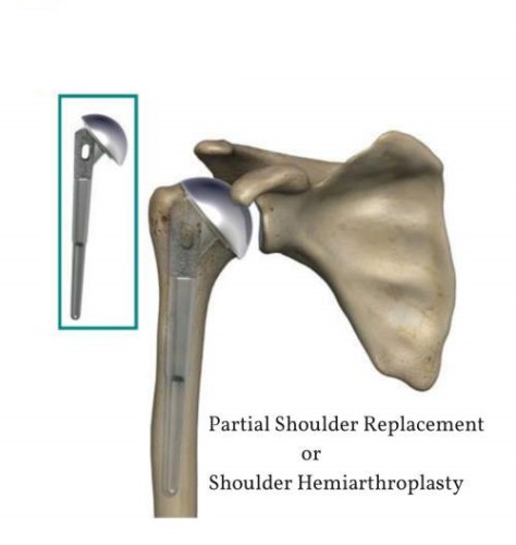 Partial Shoulder Replacement Partial Shoulder Replacement