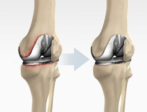 Revisional Joint Replacement Surgery