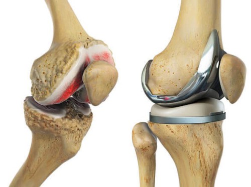 Total Knee Replacement Total Knee Replacement: What Patients Should Know