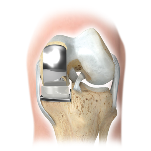Partial Knee Replacement