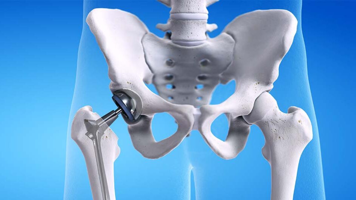 Hip Replacement Surgery