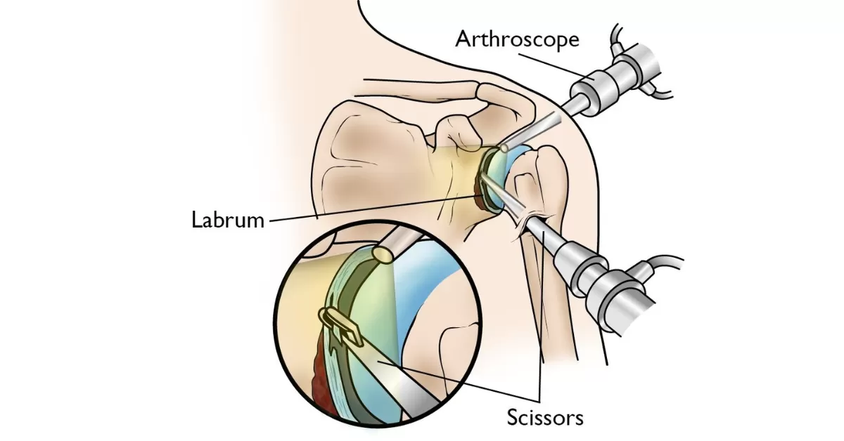 Shoulder Arthroscopy Surgery Shoulder Arthroscopy surgery