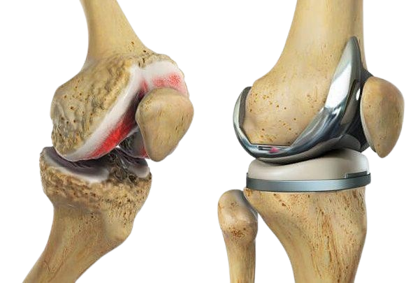Joint Replacement Surgery
