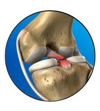 Posterior Cruciate Ligament (PCL)