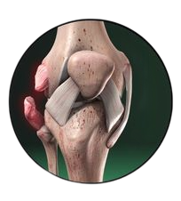 Lateral Collateral Ligament (LCL)