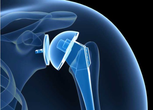 Shoulder Arthroplasty
