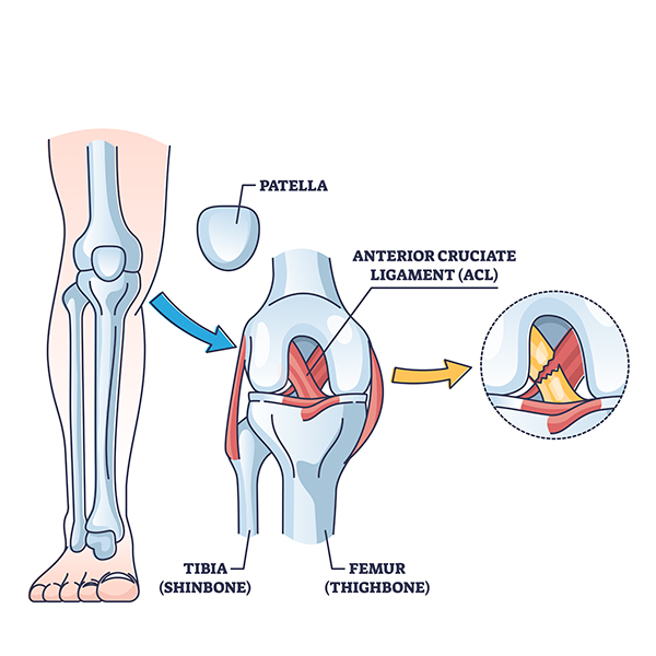 ACL Reconstruction Surgery