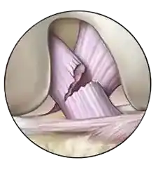 Anterior Cruciate Ligament (ACL)