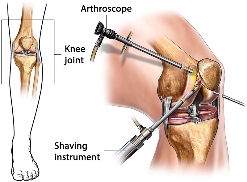 Arthroscopic Knee Surgery Knee Arthroscopy Surgery