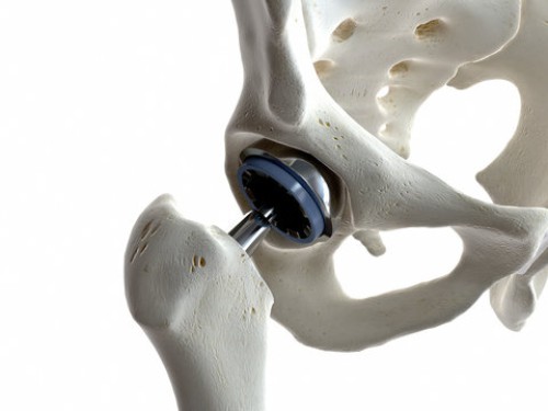 Hip Replacement Surgery