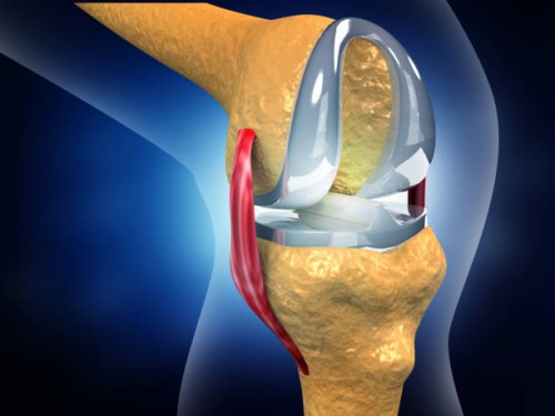 Knee Arthroplasty Knee Arthroplasty
