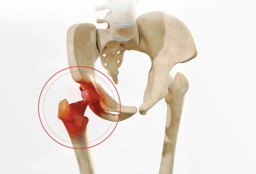 Revision Hip Replacement