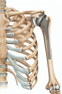 Total Shoulder Replacement