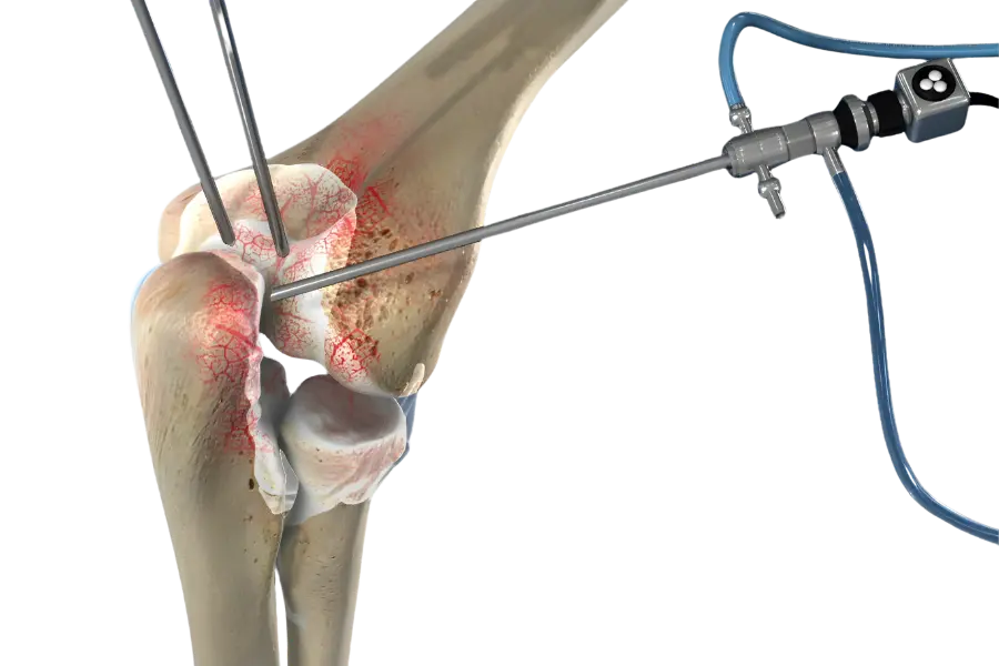 elbow-arthroscopy Elbow Arthroscopy