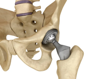 Total Hip Replacement