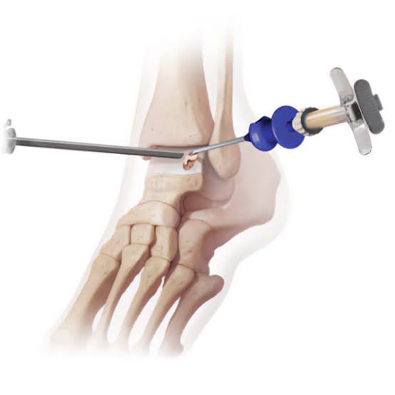 Ankle Arthroscopy Ankle Arthroscopy