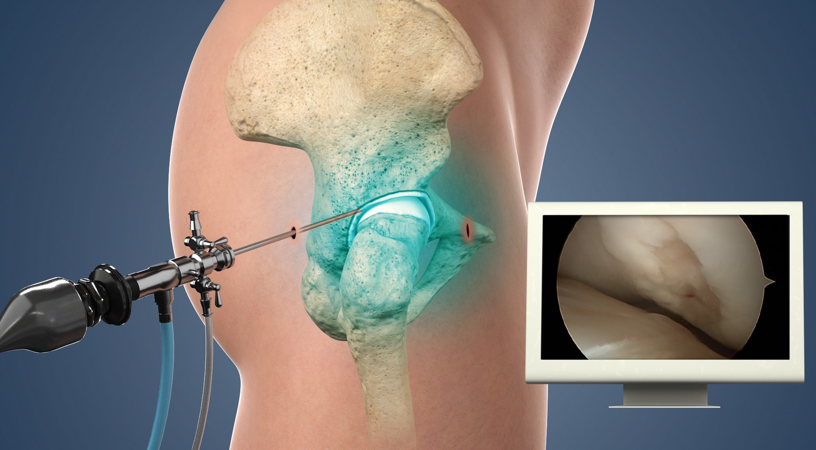 Hip Arthroscopy