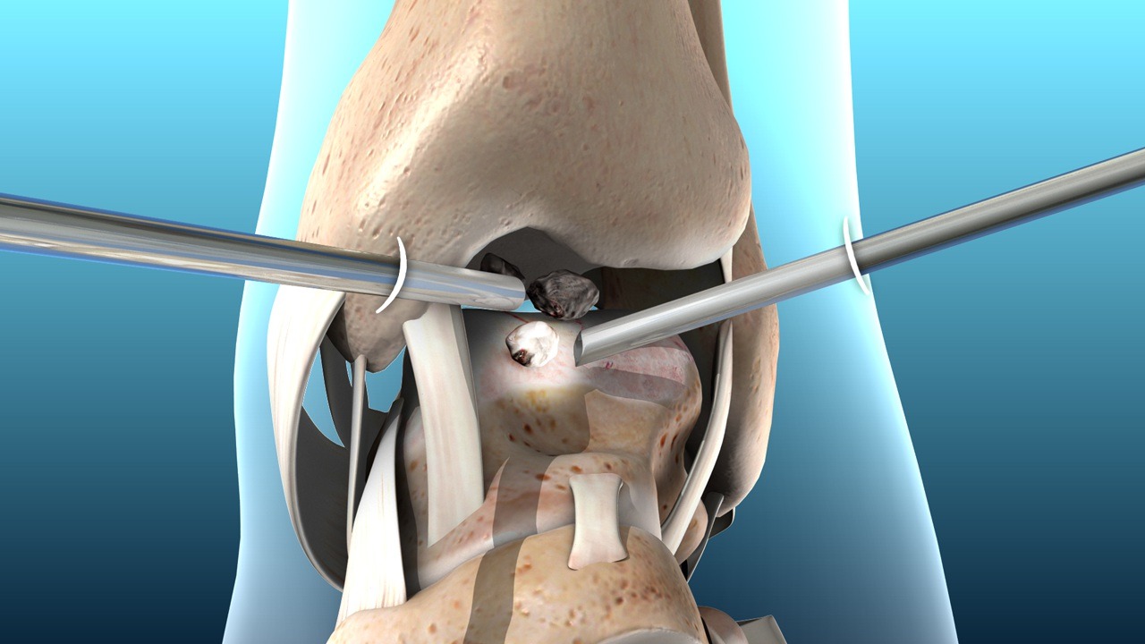 Ankle Arthroscopy