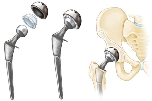 Hip Arthroplasty