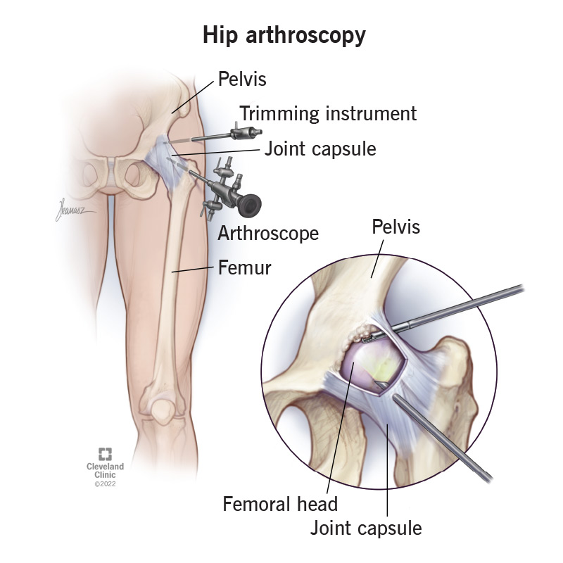 hip-arthroscopy