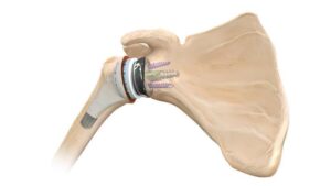 Reverse Shoulder Replacement