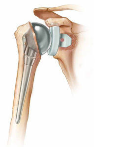 total sholder replacement Total Shoulder Replacement