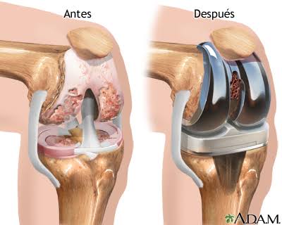 Knee Arthroplasty